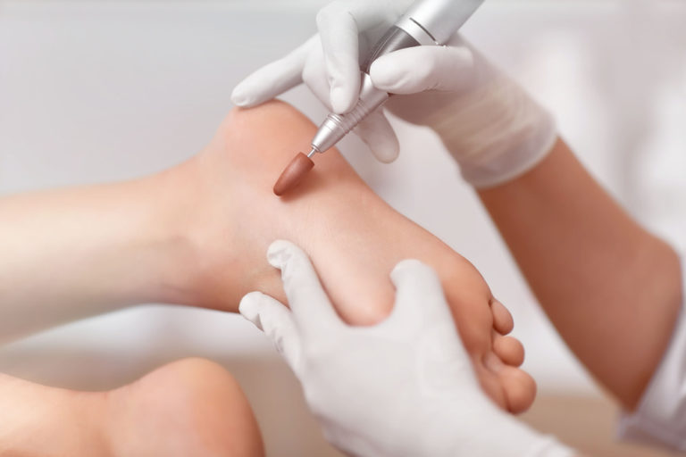 Close up of podiatrist using special grinding equipment and making procedure polish for feet.